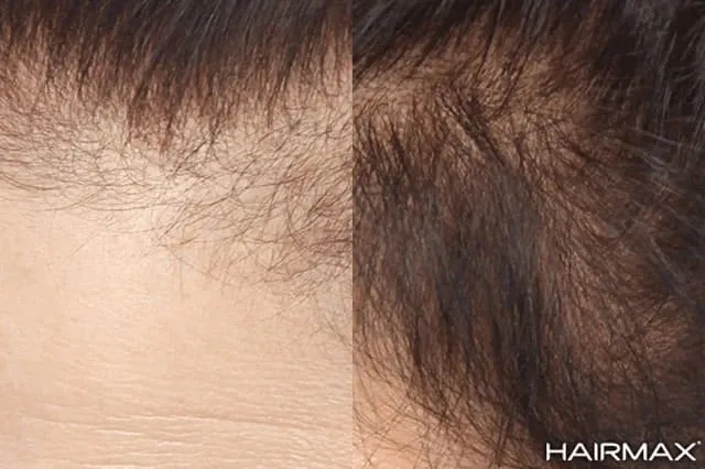 laser na wypadanie włosów opinie